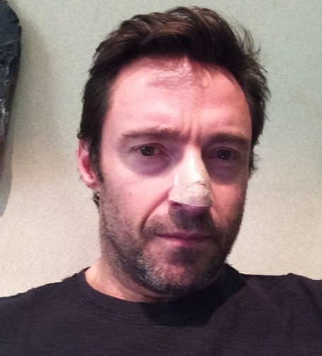 Hugh Jackman postet dieses Bild von sich auf Instagram nachdem ihm gefährliche Krebszellen entfernt wurden. © instagram/hughjackman